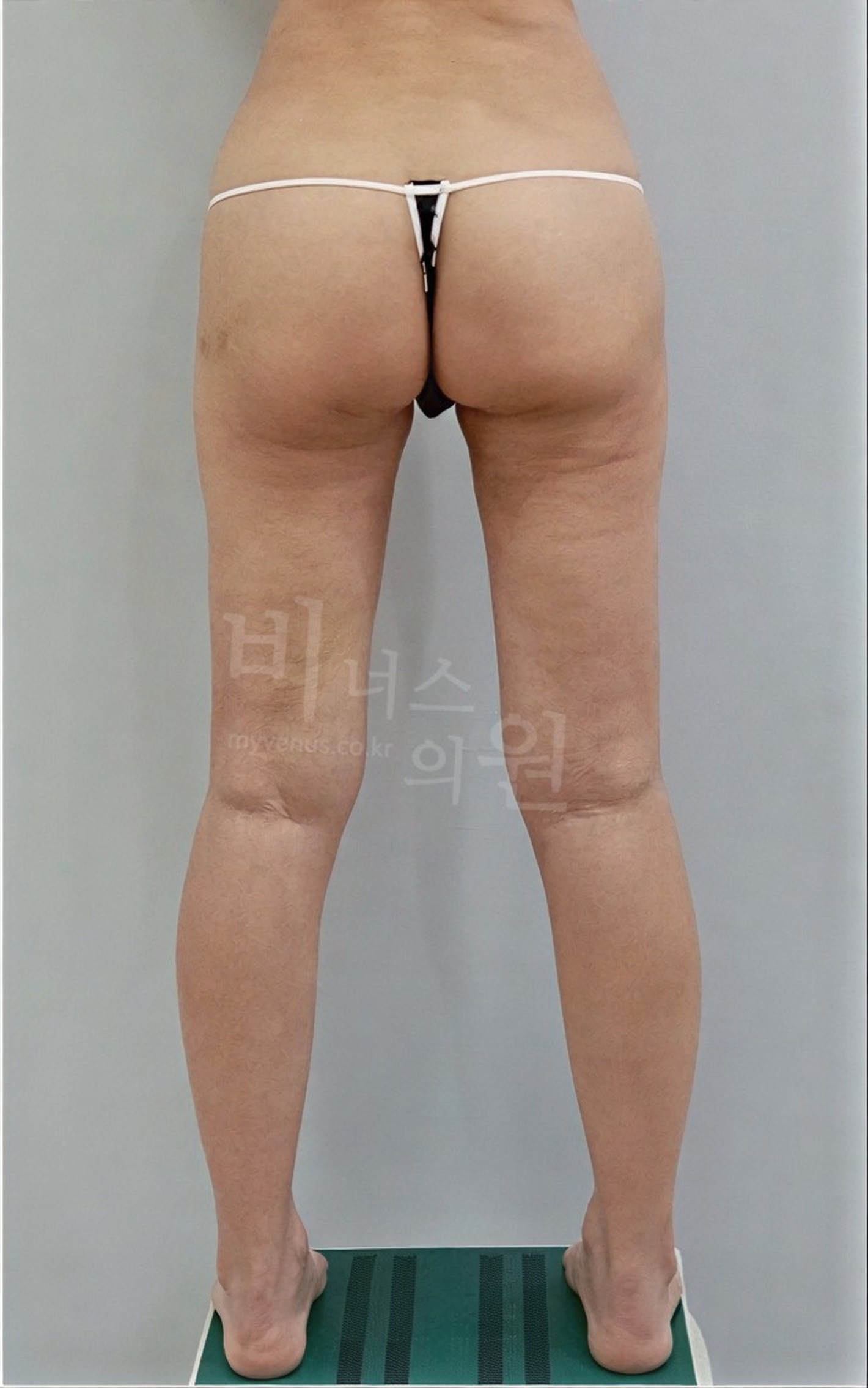 엉덩이 지방흡입 지방이식 수술 후 후면 다른 컷 비너스의원