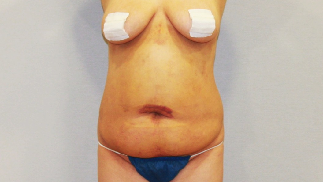 복부 뱃살 옆구리 뒷구리 윗배 아랫배 흉부 러브핸들 지방흡입 수술전 수술후 1주후 4주후 경과 후기 사진.JPG