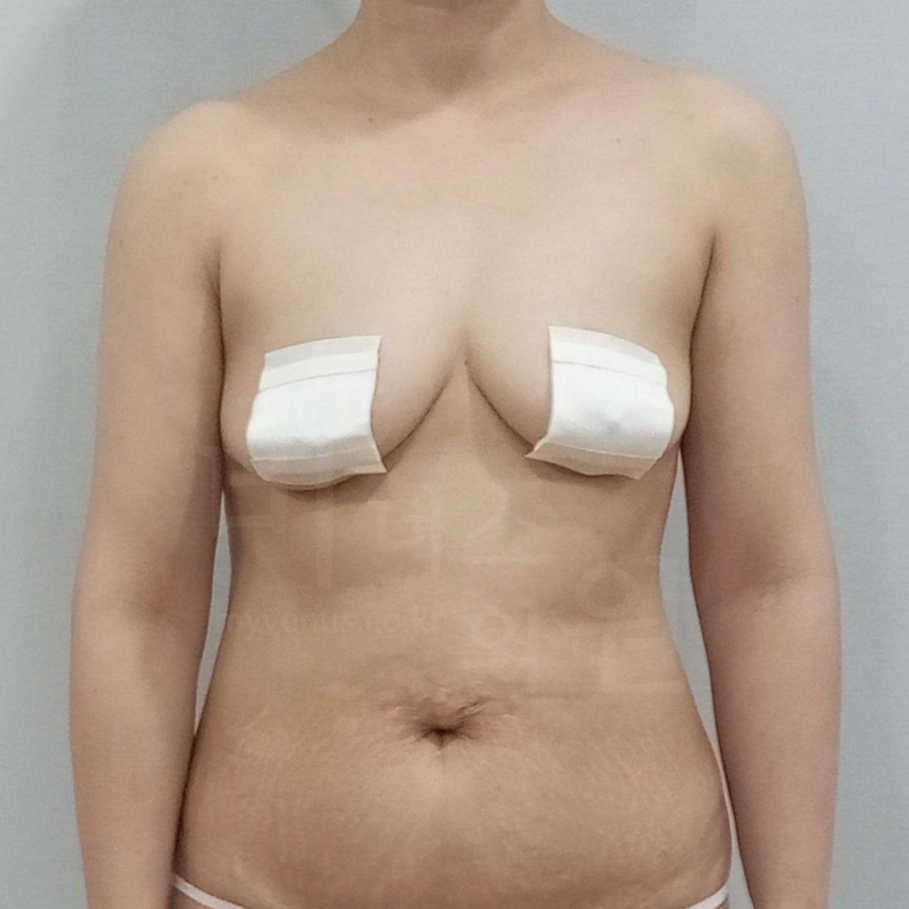 팔뚝지방흡입 수술 후 정면 차렷 자세 비너스의원