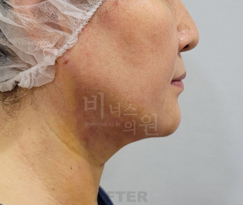 얼굴 지방흡입 수술 후 좌측면 턱과 목 라인 비너스의원