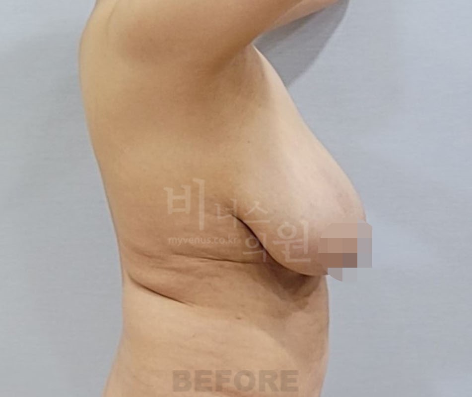 유방처짐 표층 지방흡입 수술 전 측면 팔을 올린 자세 비너스의원