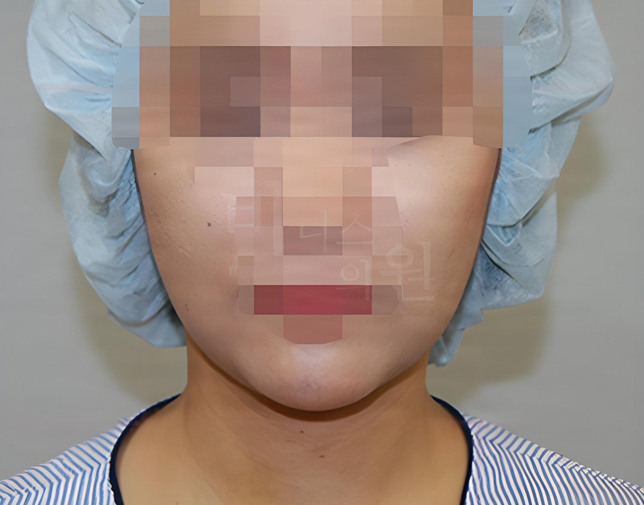 턱 지방흡입 수술 후 정면 사례 1 비너스의원