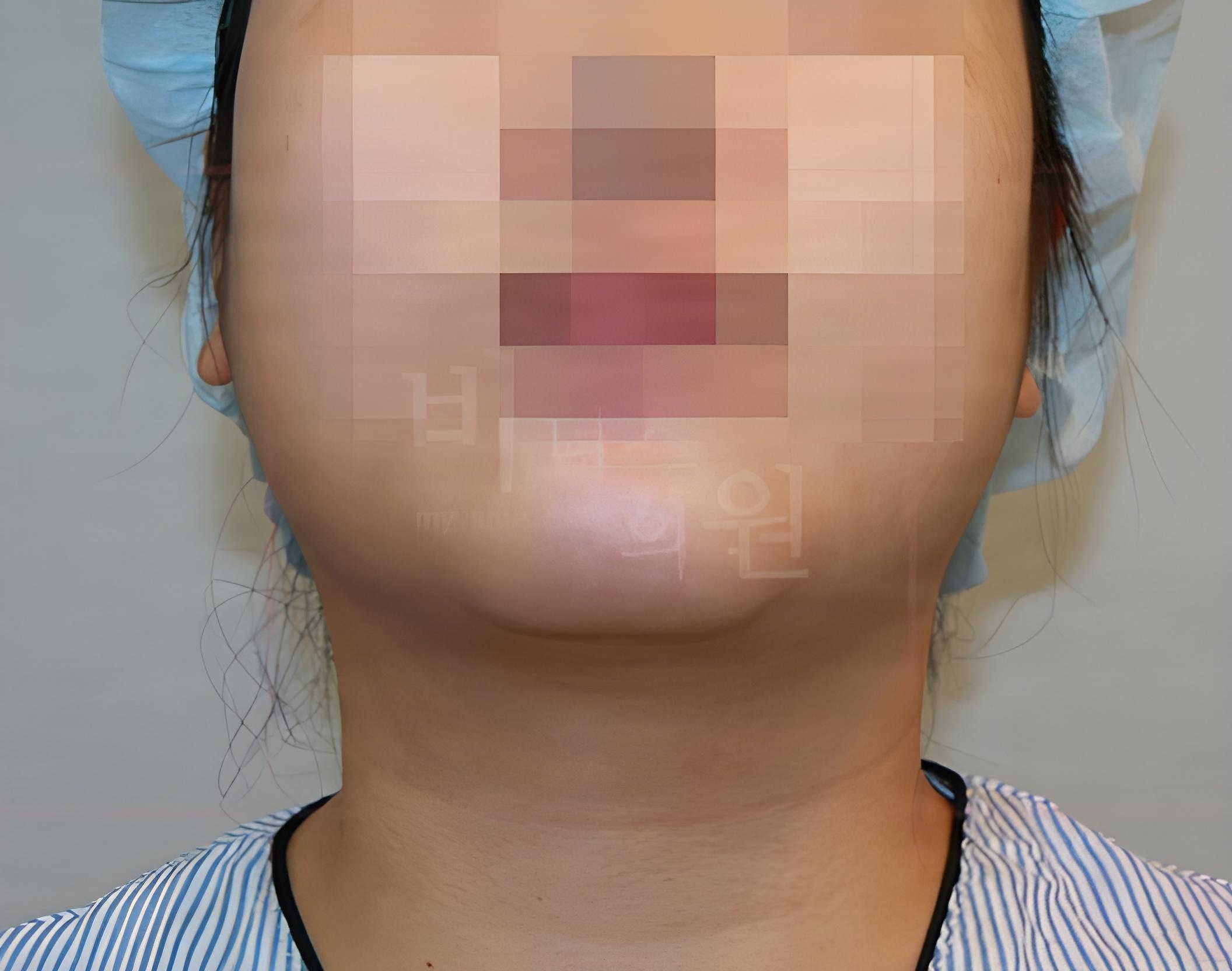턱 지방흡입 수술 전 정면 사례 2 비너스의원