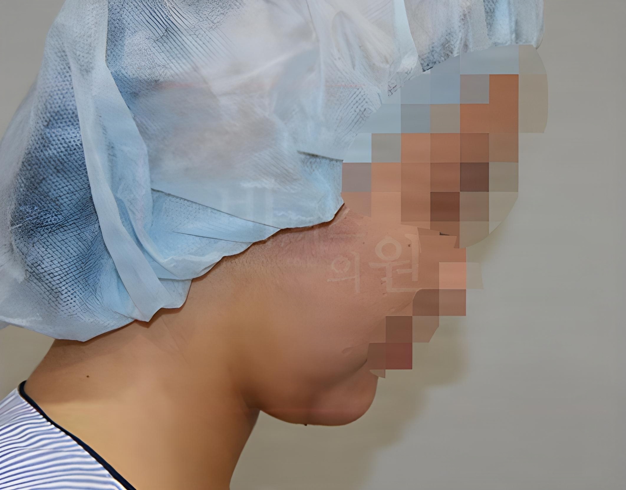 턱 지방흡입 수술 후 측면 사례 1 비너스의원