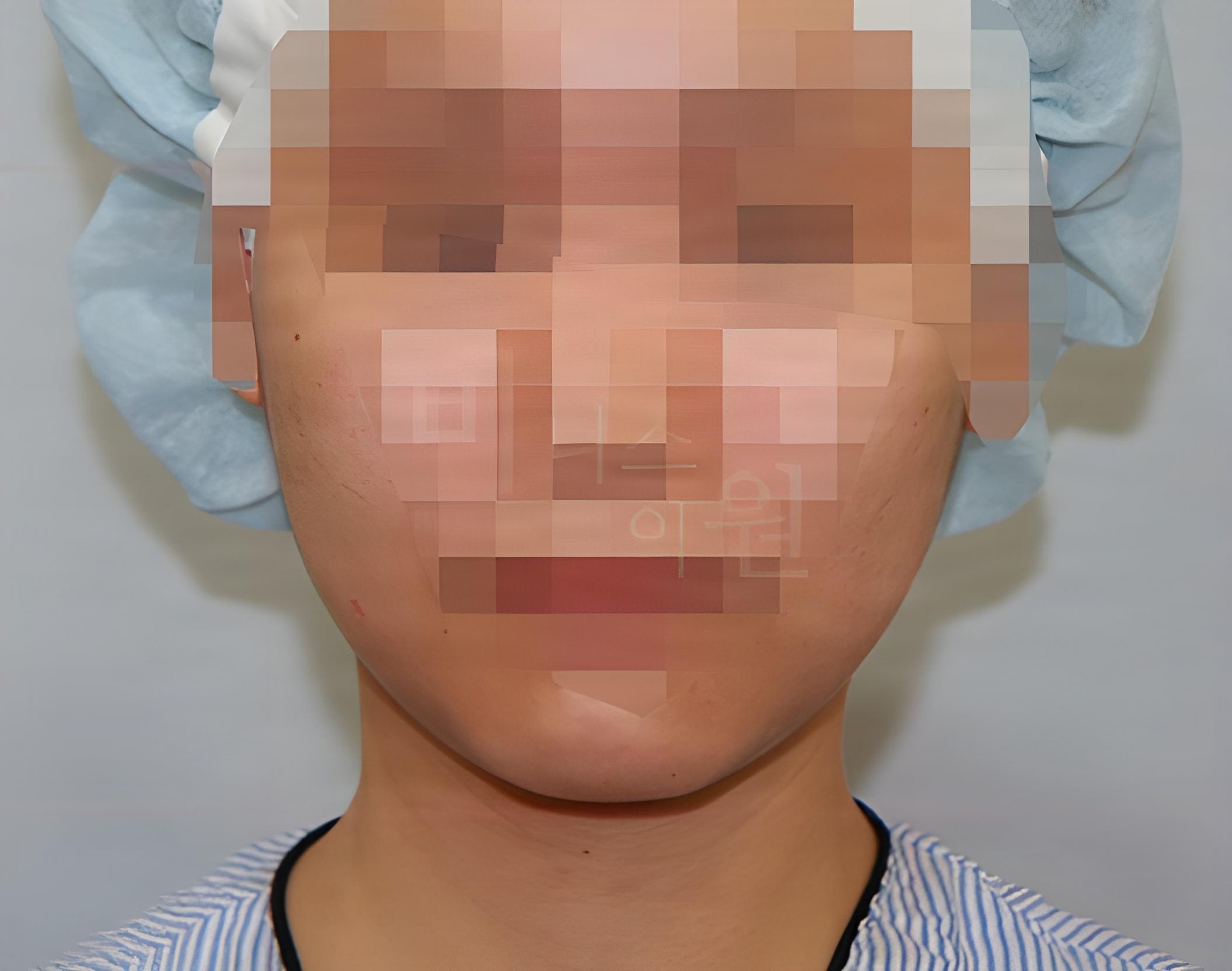 턱 지방흡입 수술 전 정면 사례 1 비너스의원