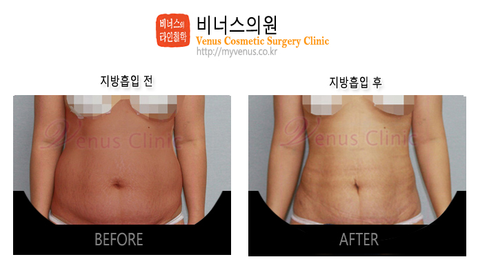 복부지방흡입.jpg