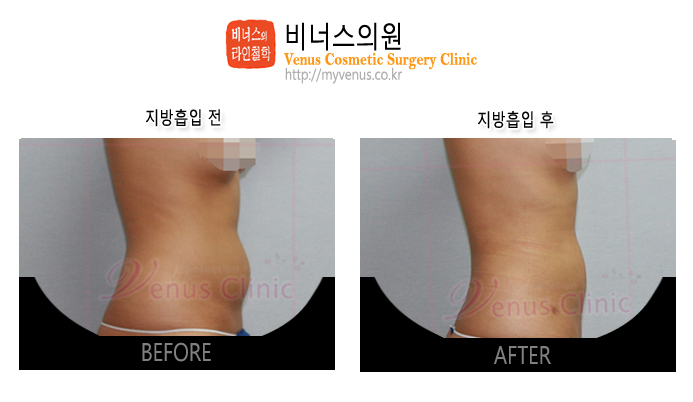 복부지방흡입4.jpg
