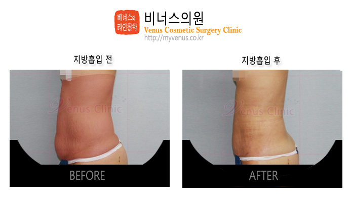 복부지방흡입1.jpg