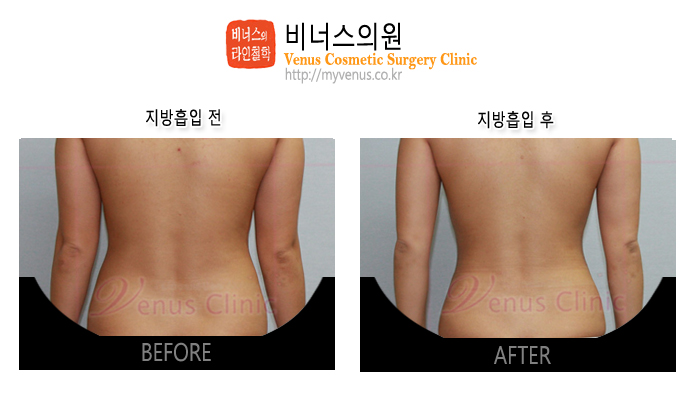 복부지방흡입5.jpg