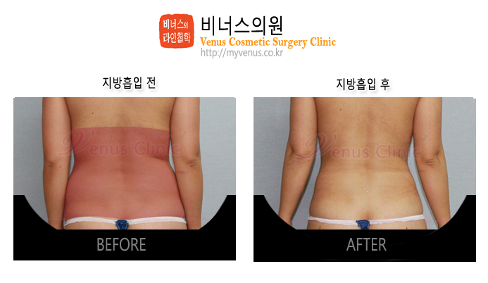 복부지방흡입2.jpg