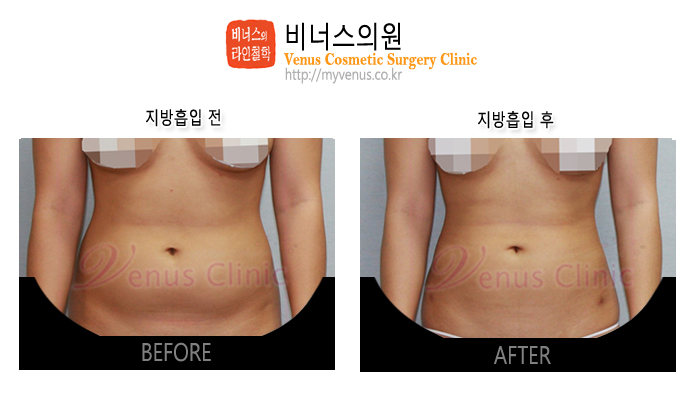 복부지방흡입3.jpg