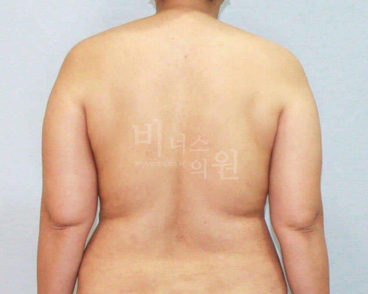 팔뚝 지방흡입 전후 — 등·후면(팔 내린) 수술 전 — 비너스의원
