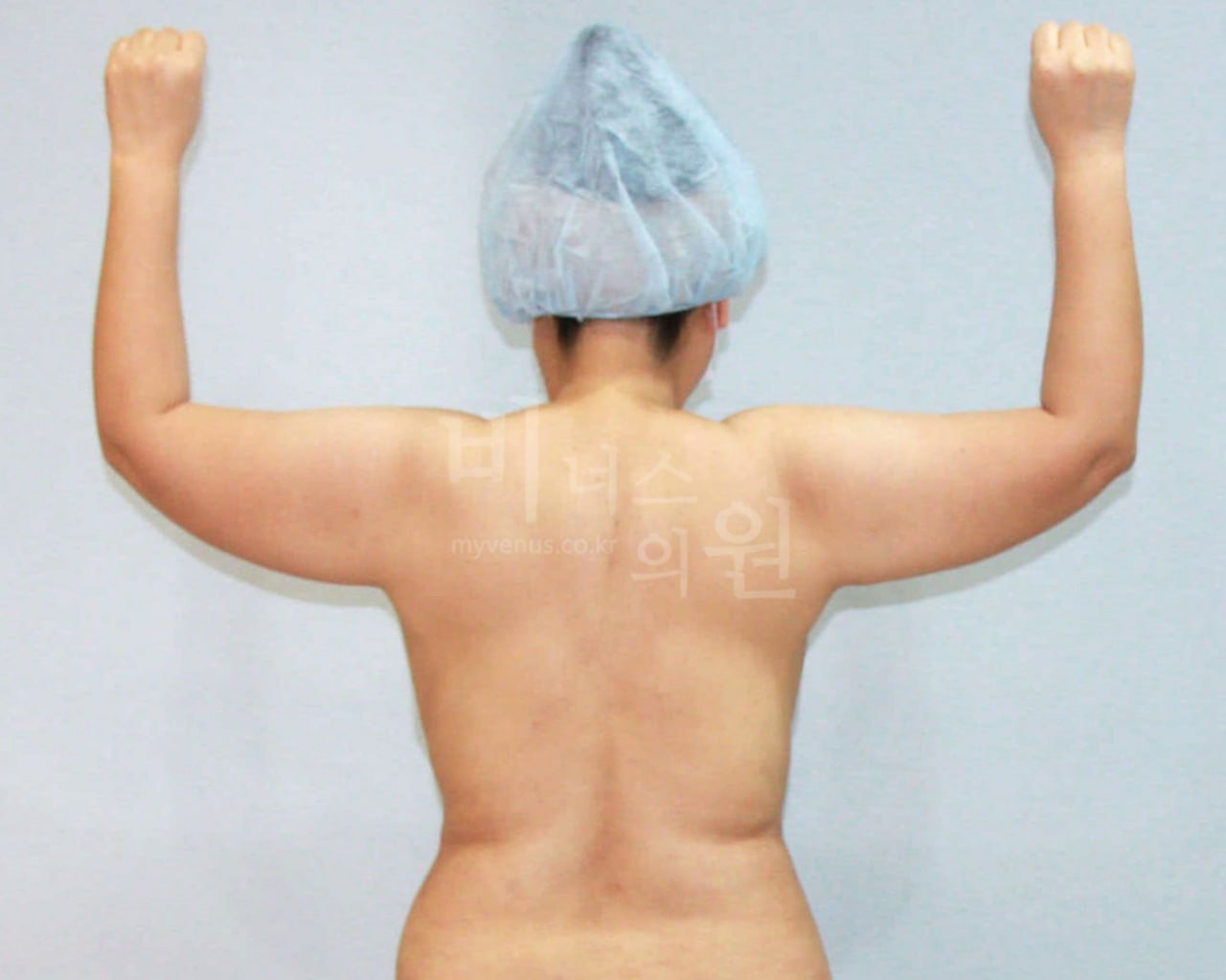 팔뚝 지방흡입 전후 — 후면(양팔 위) 수술 전 — 비너스의원