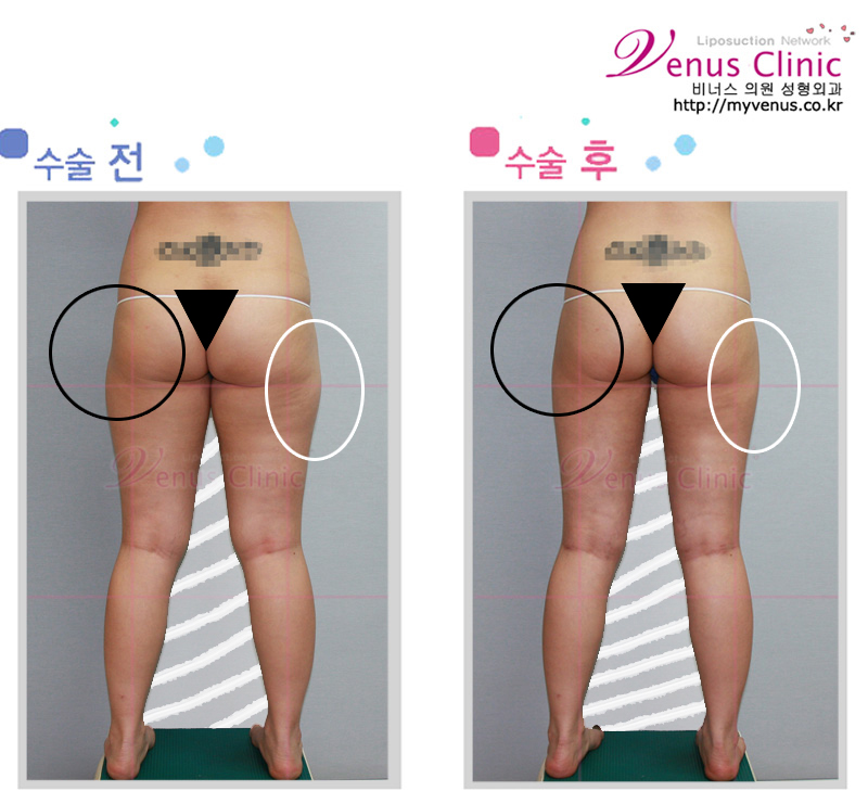 부천허벅지지방흡입.jpg