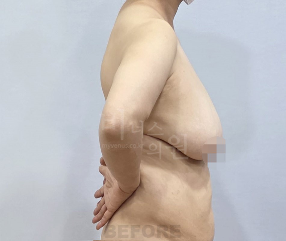 유방 지방흡입 수술 전 측면 비너스의원