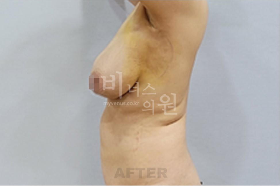 유방 지방흡입 수술 후 측면 비너스의원