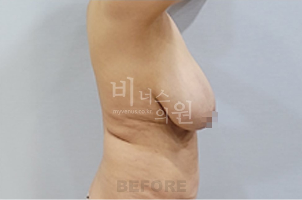 유방 지방흡입 수술 전 반대쪽 측면 비너스의원
