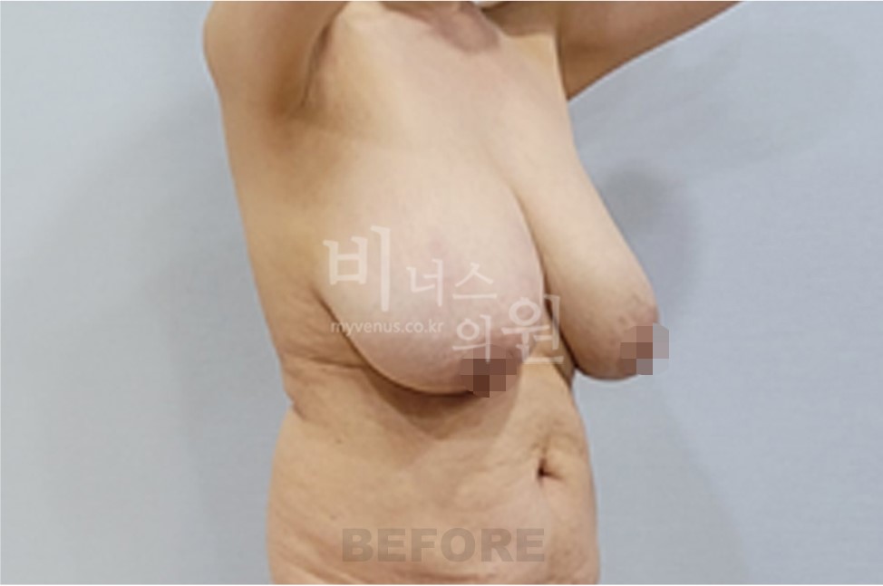 유방 지방흡입 수술 후 반대 방향 45도 측면 비너스의원