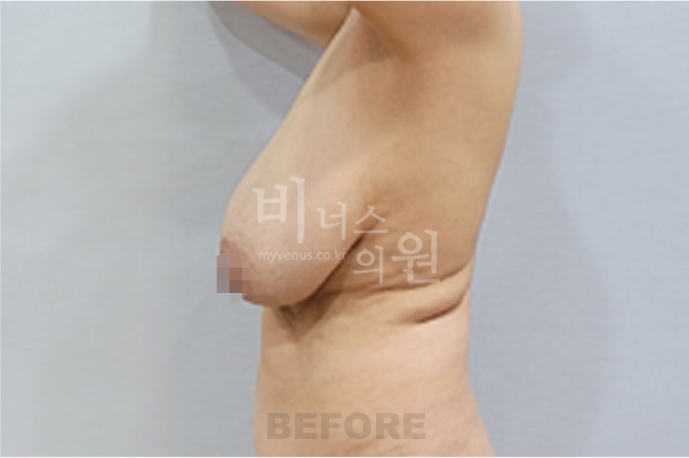 유방 지방흡입 수술 전 측면 비너스의원