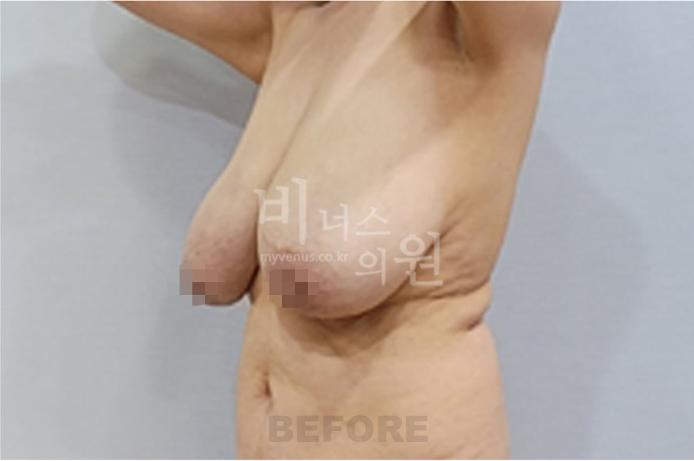 유방 지방흡입 수술 전 45도 측면 비너스의원
