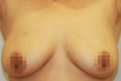 유방 가슴 축소 지방흡입 흉터 효과.jpg