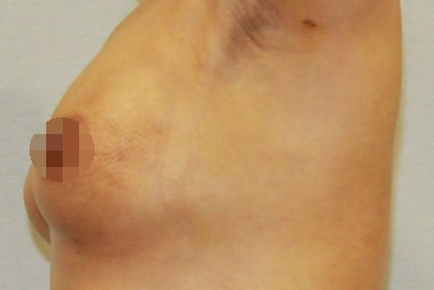 유방 가슴 축소 지방흡입 흉터 효과 절개.JPG