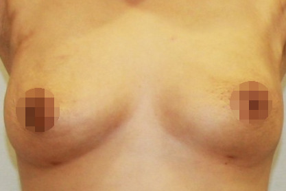 가슴 유방 축소 지방흡입 효과 흉터 절개.JPG