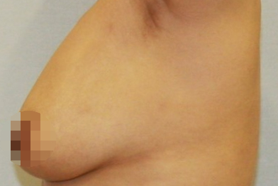 유방 가슴 축소 지방흡입 효과 흉터 절개.JPG