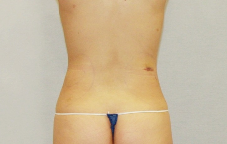 복부뒷구리지방흡입1주일경과 (1).JPG