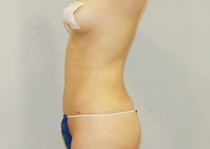 복부아랫배하복부지방흡입1주일 (1).JPG