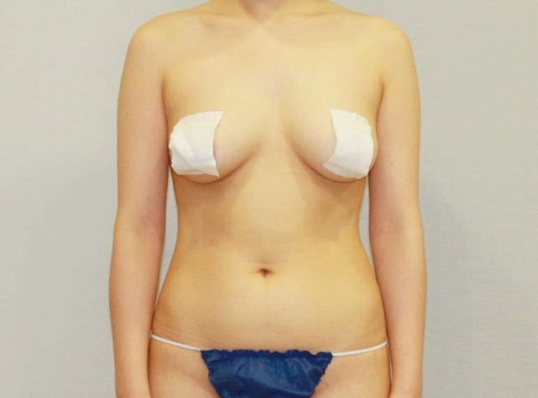 복부지방 (1).JPG