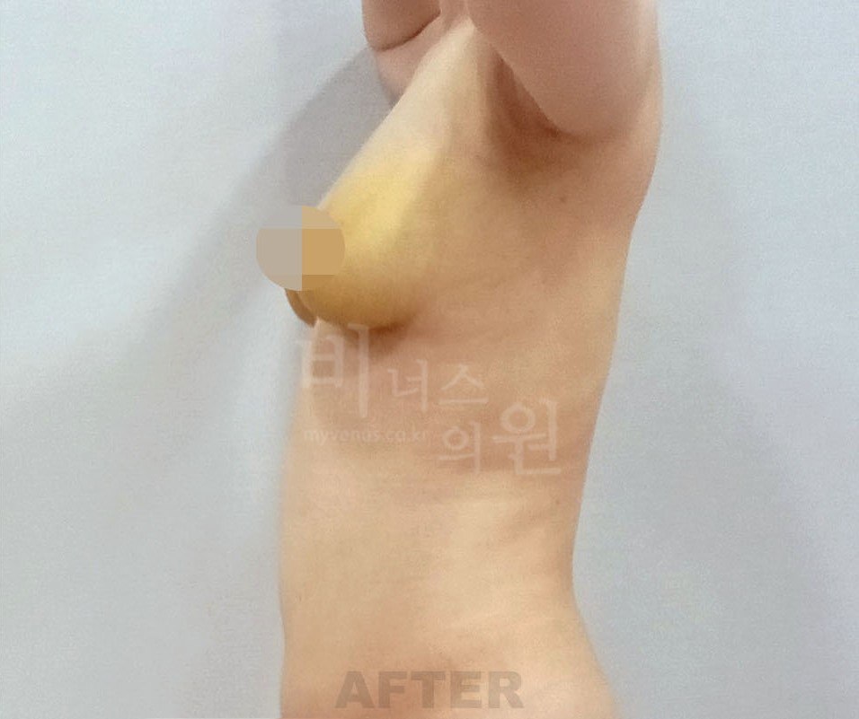 가슴 지방흡입 수술 후 우측