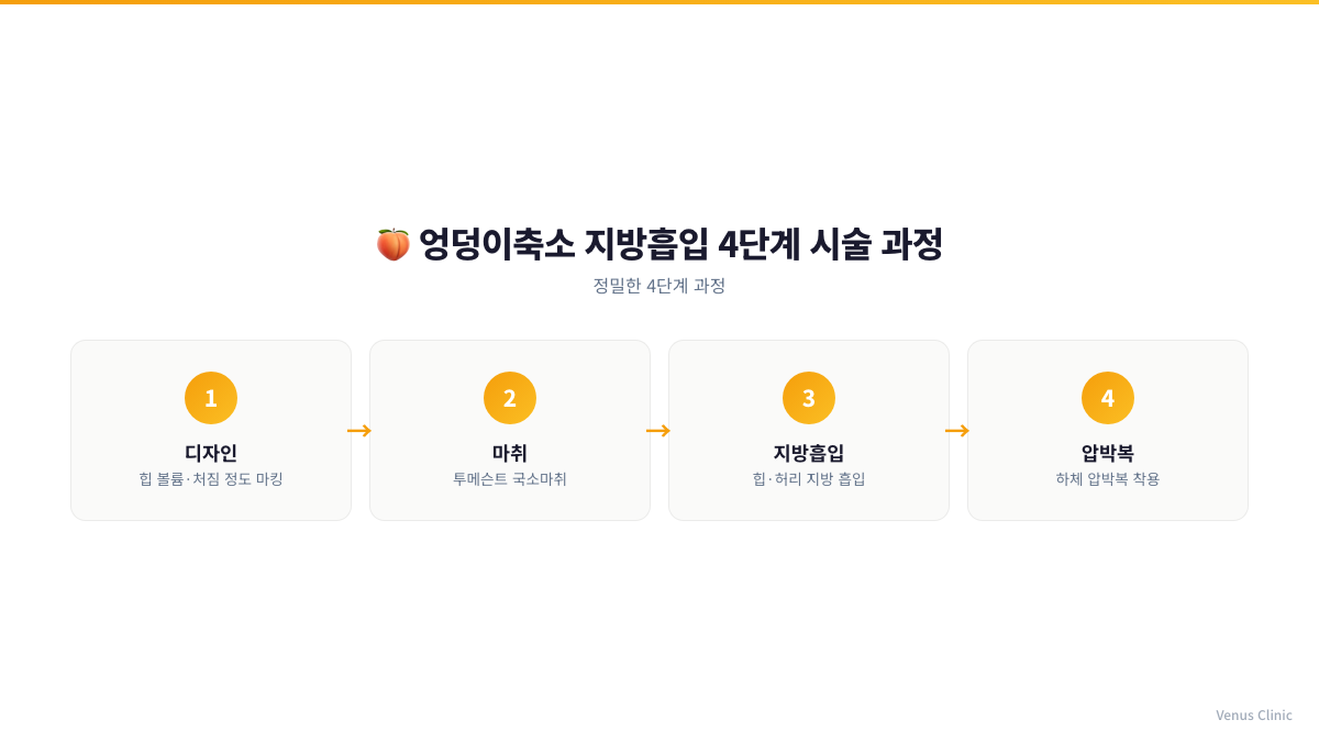 엉덩이축소 지방흡입 디자인, 마취, 지방흡입, 압박복 착용 4단계 시술 과정 인포그래픽