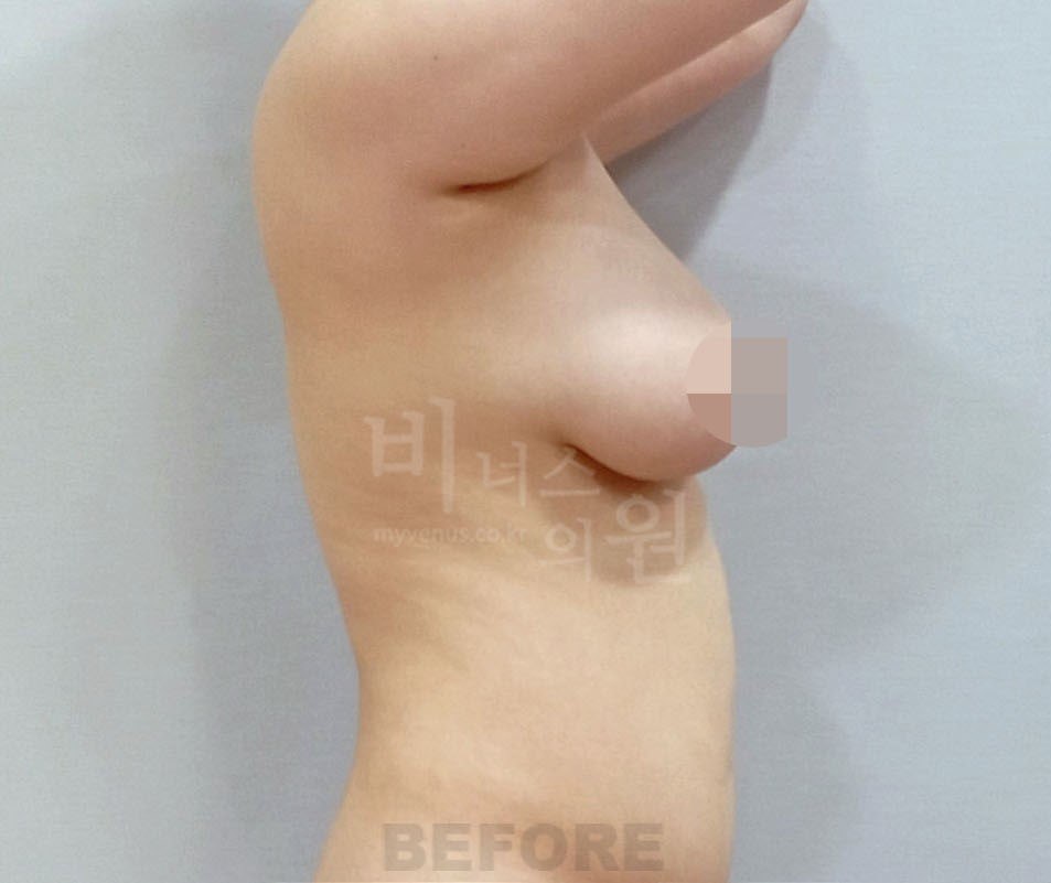 가슴 지방흡입 수술 전 좌측