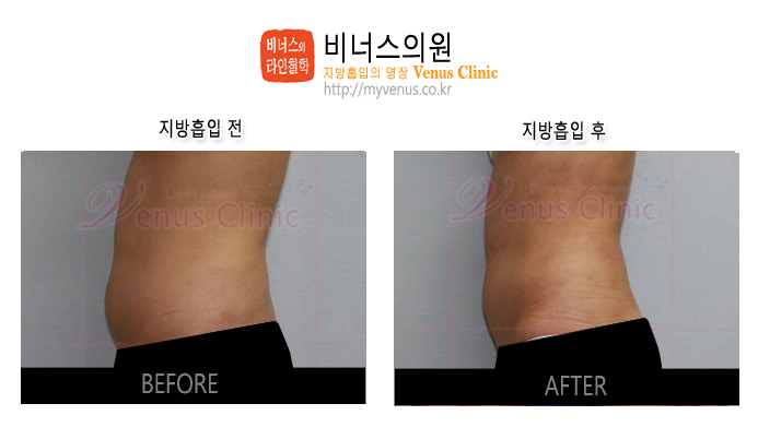 복부지방흡입 (3).jpg