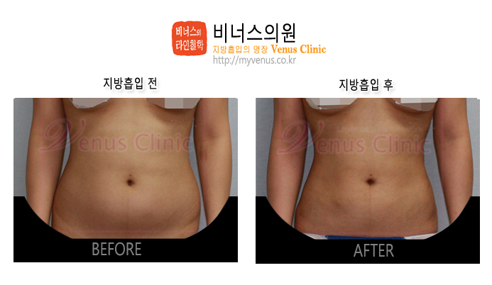 복부지방흡입 (2).jpg