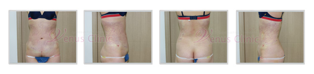 지방흡입 (92).jpg