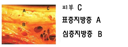 지방흡입 (21).jpg