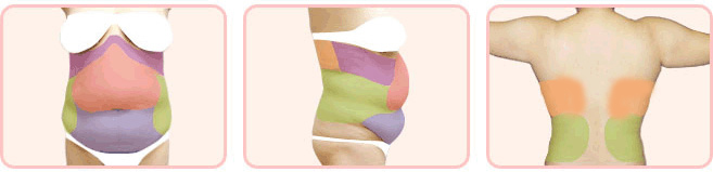 지방흡입 (94).jpg