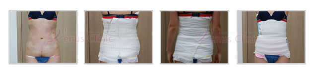 지방흡입 (93).jpg