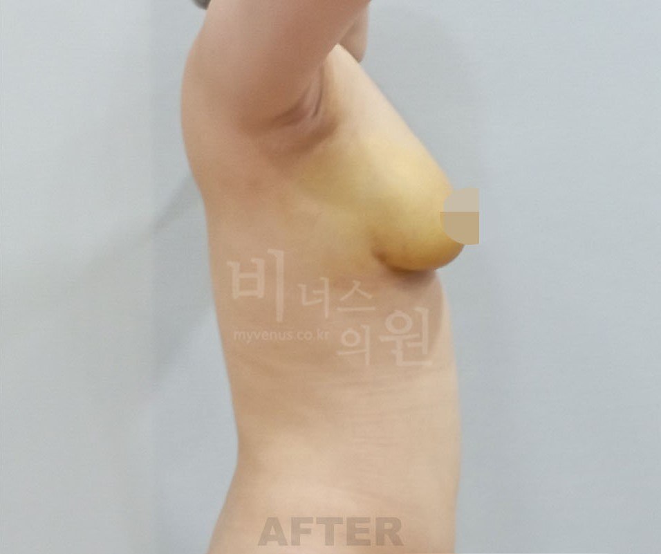 가슴 지방흡입 수술 후 좌측