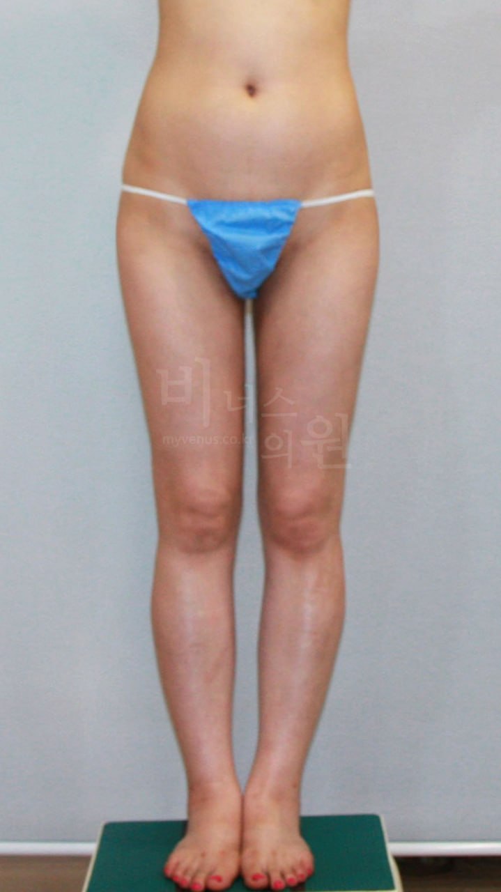엉덩이 볼륨업 지방흡입 수술 후 정면 비너스의원