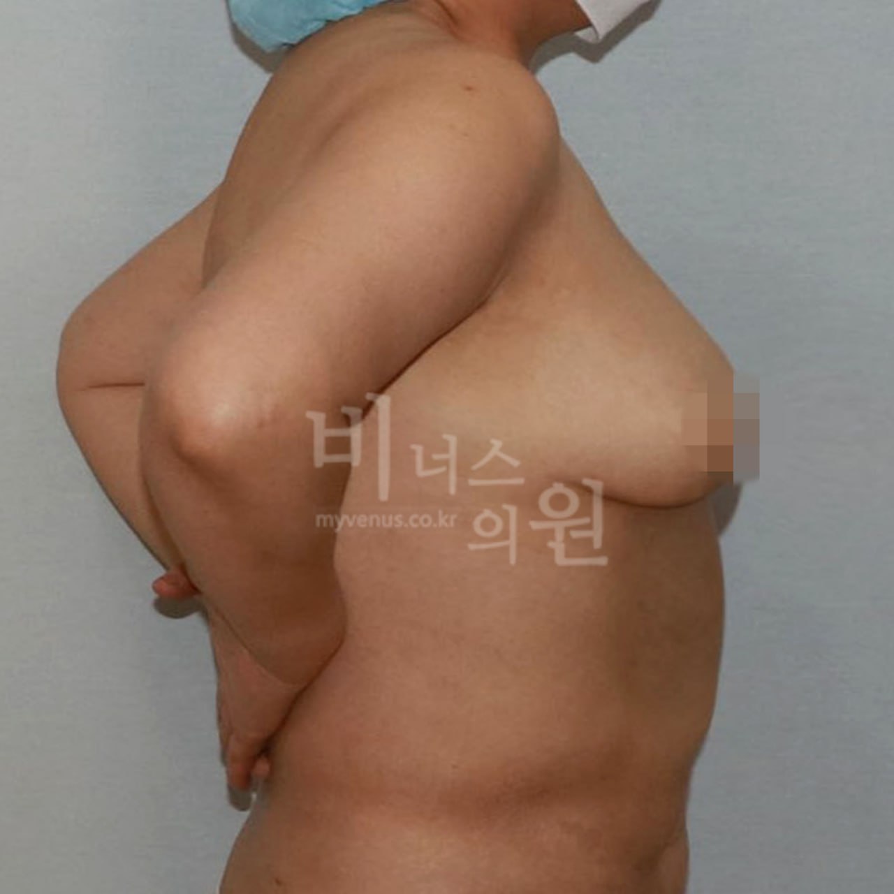 가슴축소 지방흡입 전후사진 수술 후 비너스의원