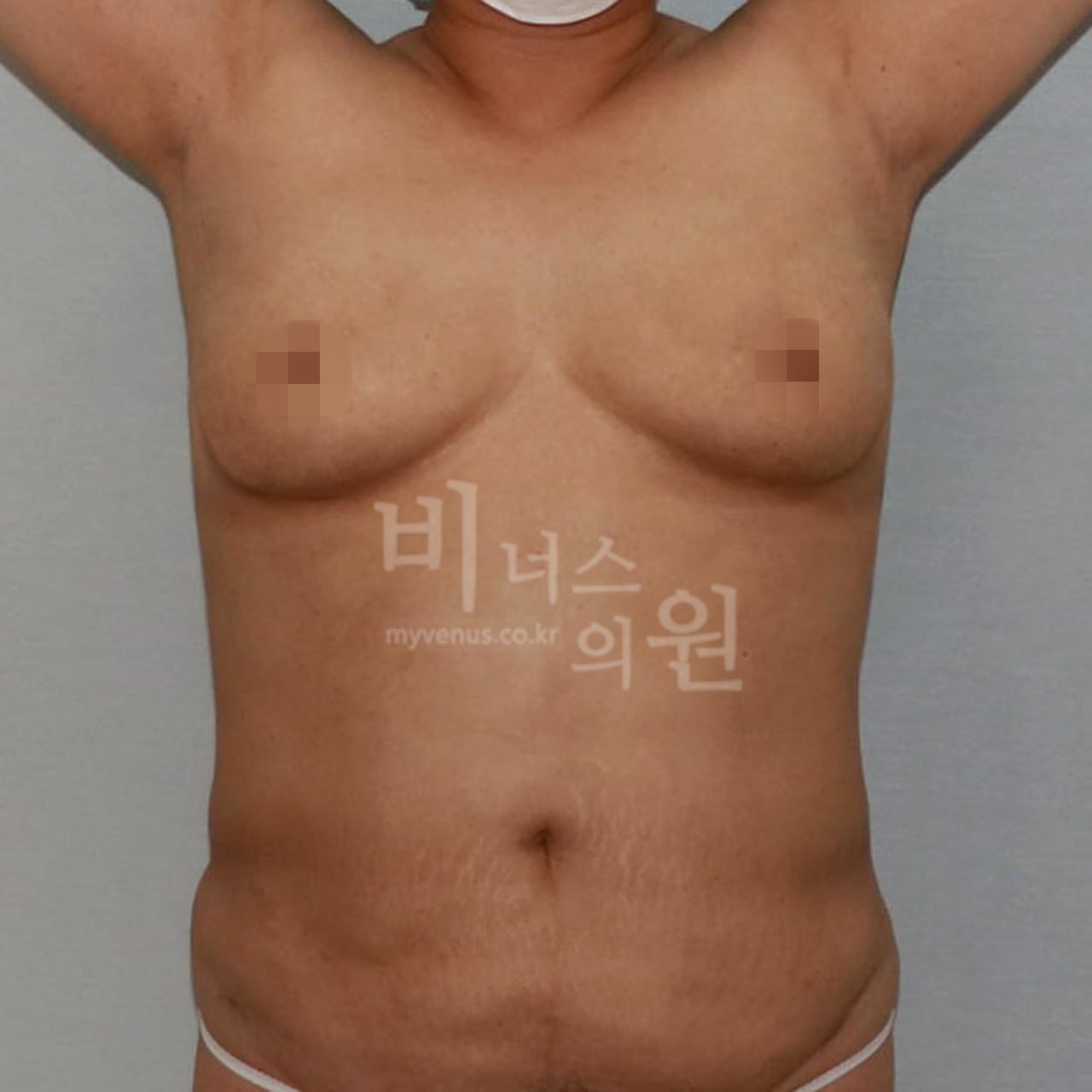 가슴축소 지방흡입 전후사진 수술 후 비너스의원