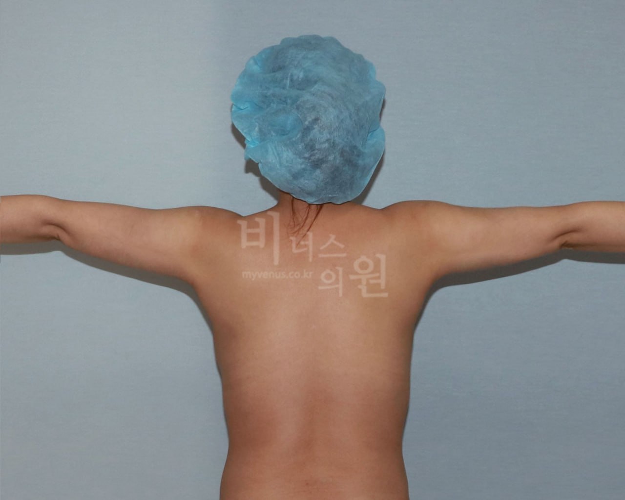 팔뚝 지방흡입 수술 후 후면 팔 T자 벌림 비너스의원