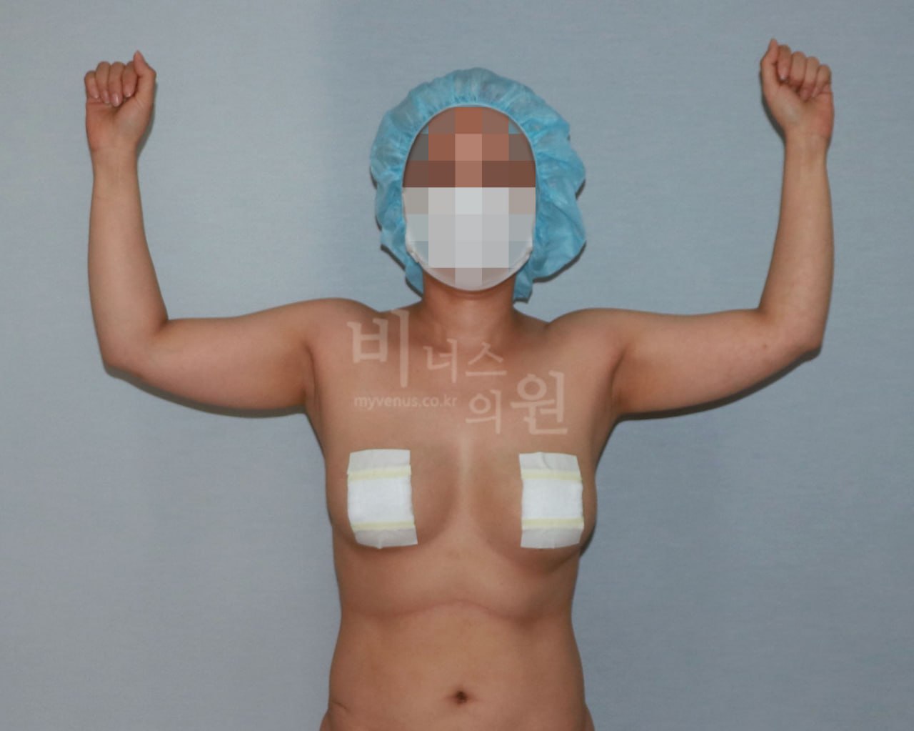 팔뚝 지방흡입 수술 전 정면 팔 위로 올린 자세 비너스의원
