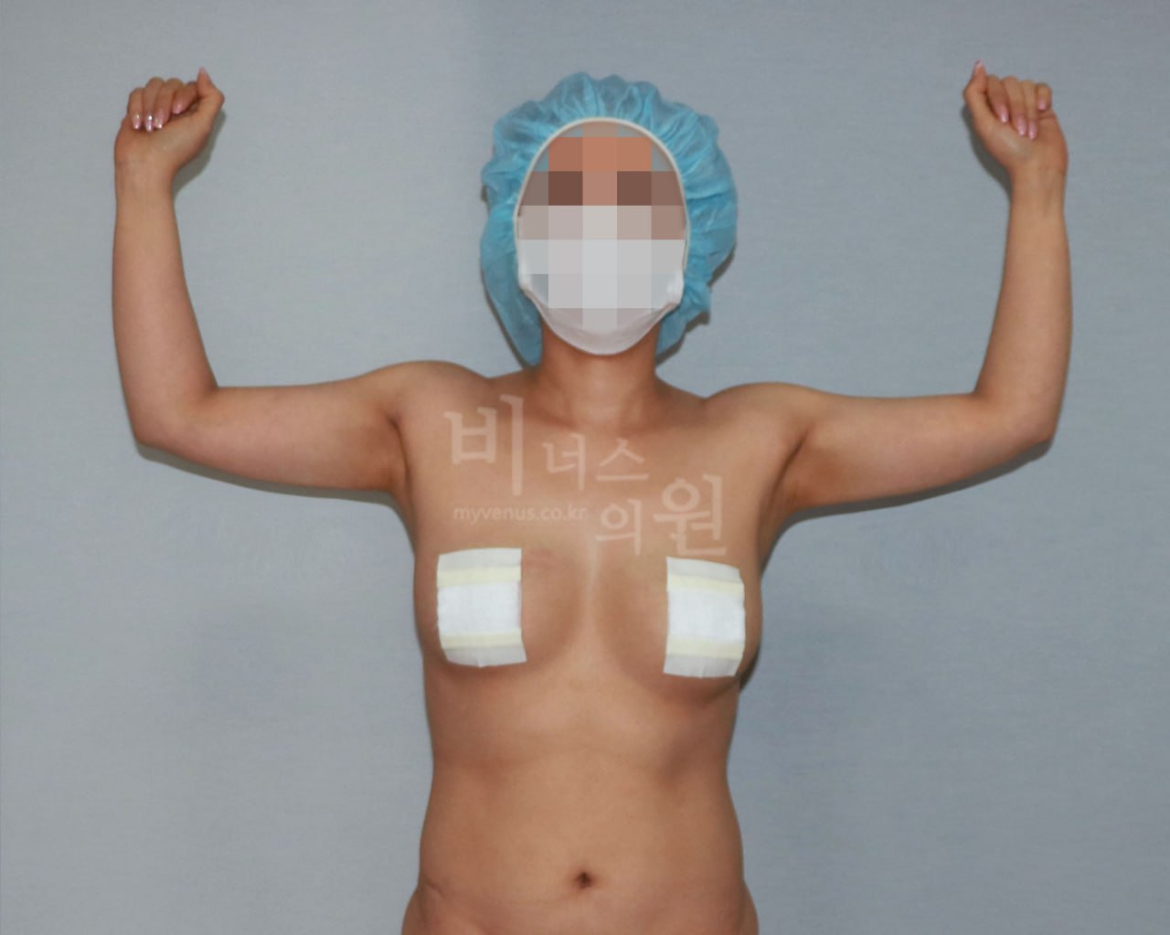 팔뚝 지방흡입 수술 후 정면 팔 위로 올린 자세 비너스의원