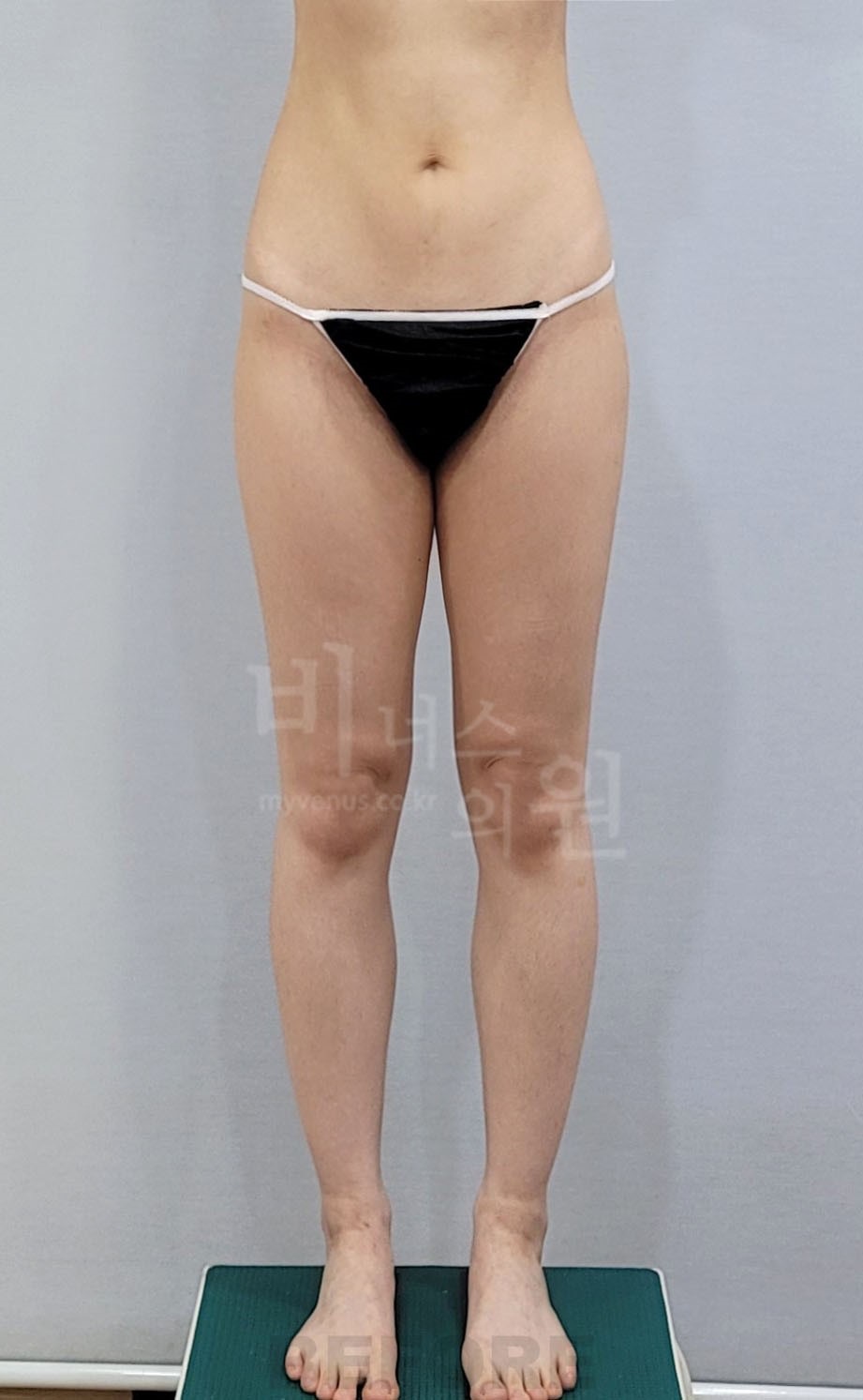 엉덩이축소 지방흡입 수술 전 정면 두 번째 자세 비너스의원