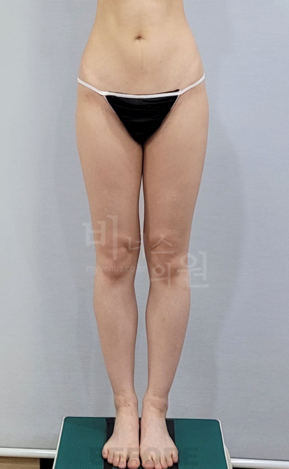 엉덩이축소 지방흡입 수술 전 정면 비너스의원