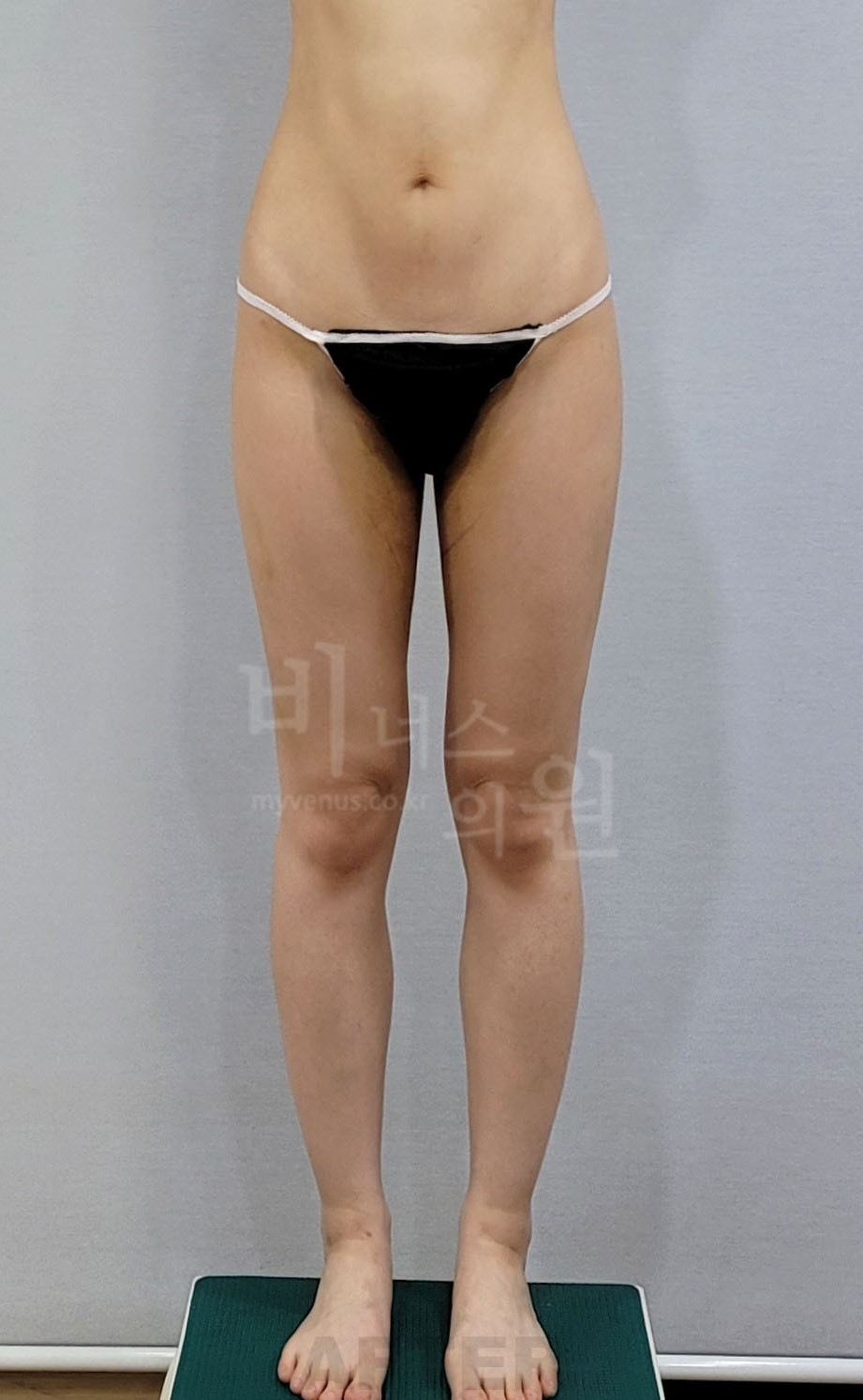 엉덩이축소 지방흡입 수술 후 정면 두 번째 자세 비너스의원